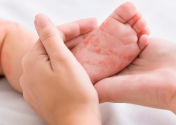 Қазақстанда қызылшаға байланысты шұғыл шаралар енгізілді